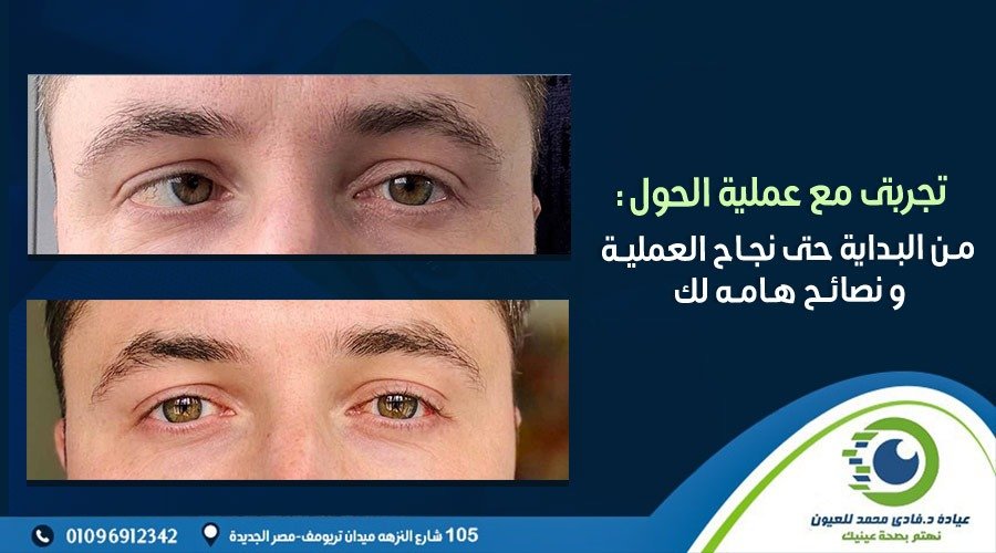 تجربتى مع عملية الحول