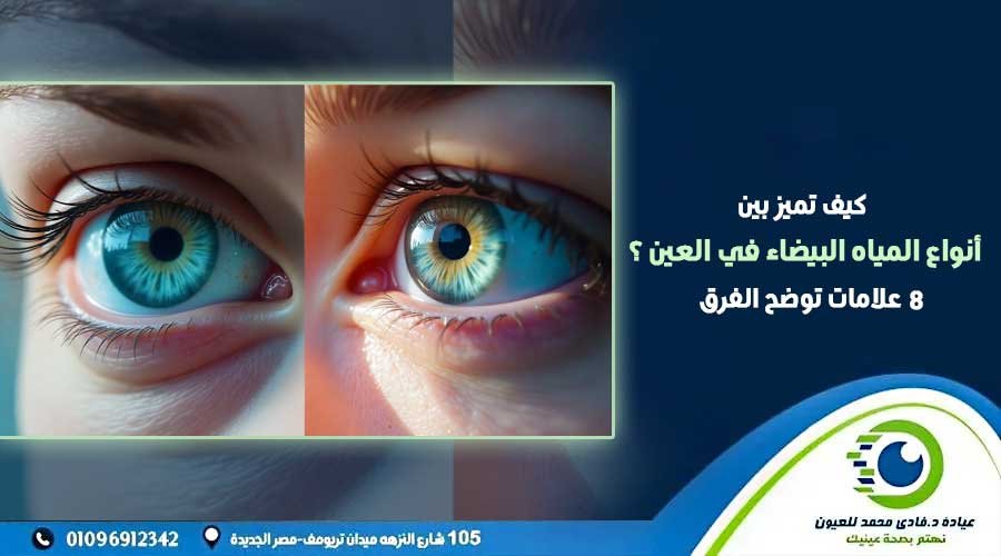 انواع المياه البيضاء في العين